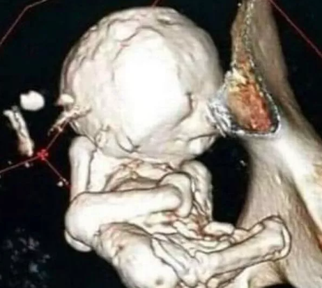 73 yaşlı qadının qarnından 35 illik DÖL ÇIXARILDI