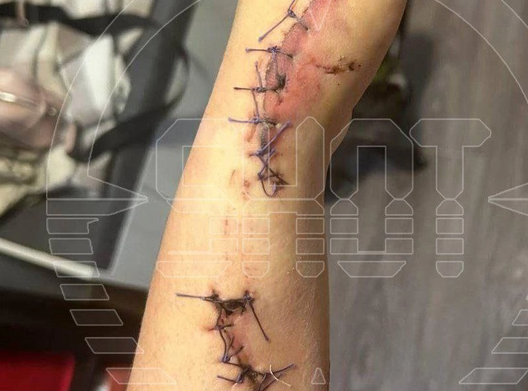 Rusiyada kişi sevgilisi masajçı işləməsin deyə əllərini kəsib