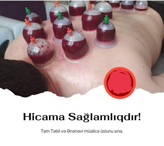 "Bir gün Allah göstərməsin, kimsə hicamadan vəfat edərsə..." - Səhv hicamanın fəsadları AÇIQLANDI