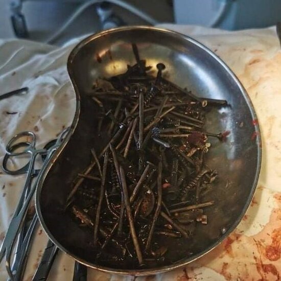 Kişinin mədəsindən 233 əşya çıxarıldı - Həkimlər şokda