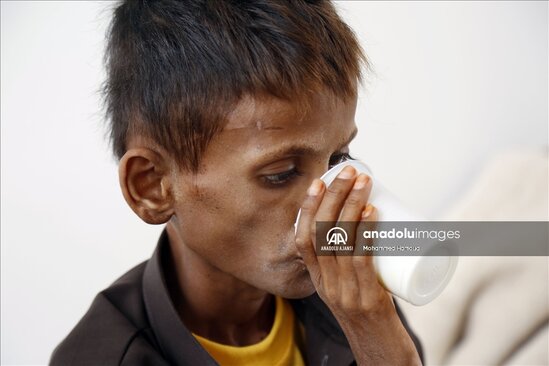 Yəməndəki uşaqların halı ürək ağrıtdı - FOTOLAR