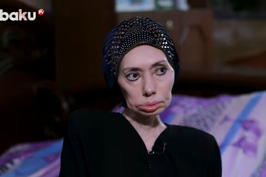 Ayna Sultanovanın nəticəsi: "Erməni tibb bacısı məni əlil etdi" – VİDEO