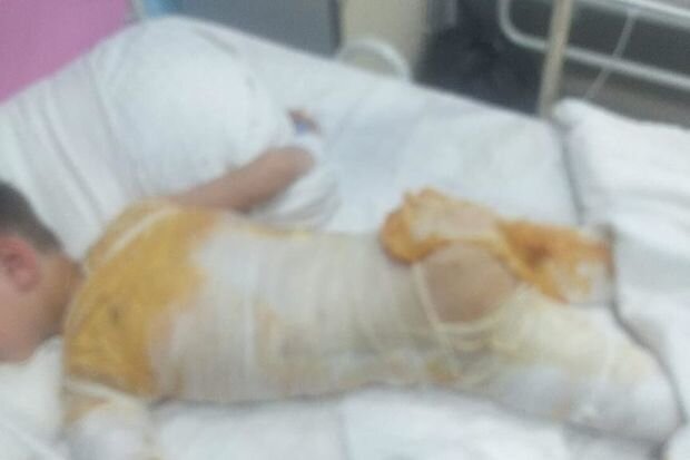 Bütün bədəni yanan Yusifin anası: "Yemək almağa belə pulumuz yoxdur, ağlamaqdan halsız düşür" - FOTO