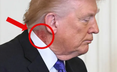Donald Trampın boynundakı qırmızı iz diqqət çəkdi - FOTO