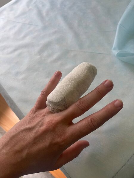 Zaxarovanın barmağı sındı - FOTO